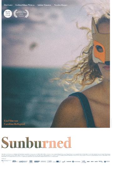 Sunburned